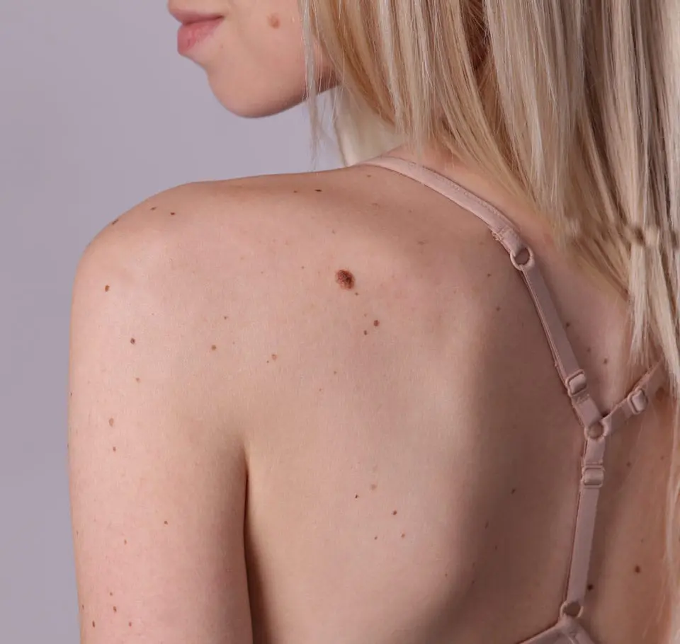 Skin Tag Removal Image